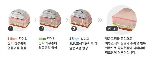 [두한성형외과 경쟁력 주름성형] - [주름제거를 위한 리프팅] 관련 이미지 28