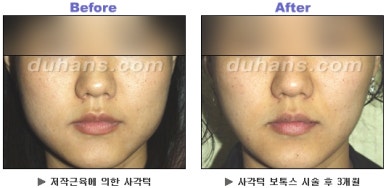 [Duhan Plastic Surgery Clinic Aesthetic Procedures] - [Square Jaw Botox] image 31