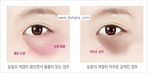 [두한성형외과 경쟁력 다크써클 치료] - [다크써클 5단계로 이뤄지는 핵심 5 STEP SOLUTION 안내 1.] 관련 이미지 6