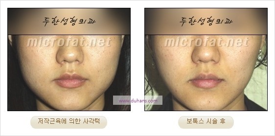 [두한성형외과 경쟁력 안면윤곽성형] - [보톡스(보툴리눔톡신)에 의한 사각턱 교정] 관련 이미지 5