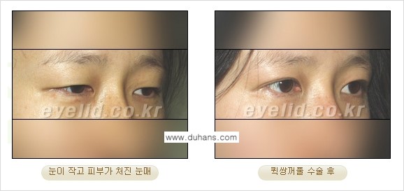 [두한성형외과 성형 FOCUS] - [퀵쌍꺼풀 수술 ④] 관련 이미지 7