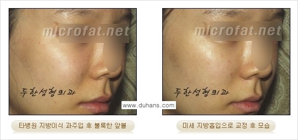[두한성형외과 경쟁력 미세지방이식] - [타 병원에서 볼살 지방이식 이후 부작용 교정 방법 안내] 관련 이미지 11