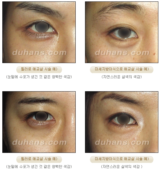 [두한성형외과 얼굴자가지방이식] - [눈밑 애교살 시술을 위한 미세지방이식] 관련 이미지 50