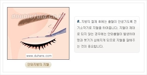 [두한성형외과 경쟁력 쌍꺼풀 재수술, 극한 재수술] - [쌍꺼풀 재수술의 과정 안내 1.] 관련 이미지 19