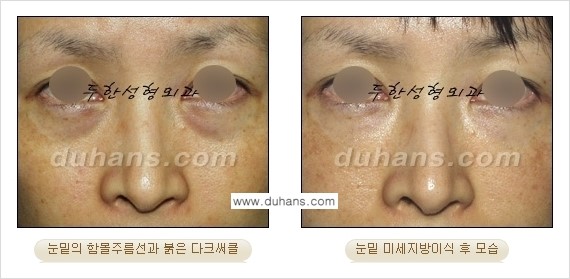 [두한성형외과 상큼하고 환한 눈매완성] - [눈밑 미세지방이식 ①] 관련 이미지 6