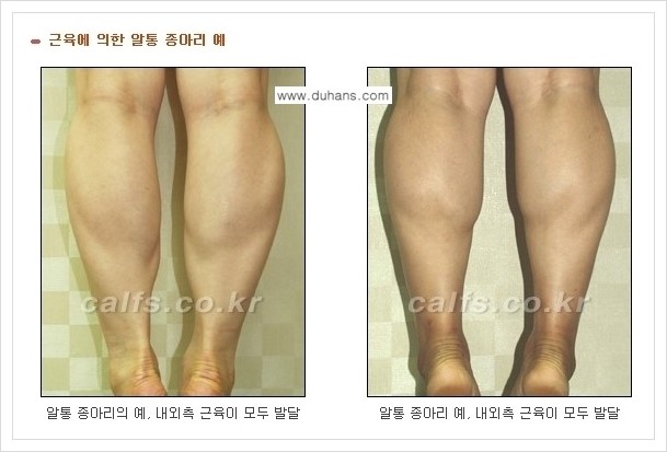 [두한성형외과 경쟁력 멀티종아리성형] - [나에게 맞는 종아리성형 방법의 종류 안내 1.] 관련 이미지 2