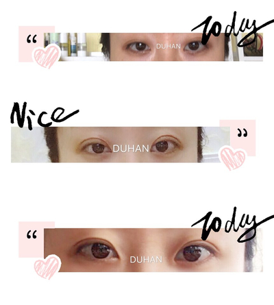 [Duhan Plastic Surgery Eye Surgery] - [First Double Eyelid Surgery] image 8