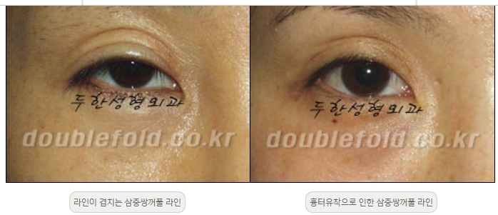 [Double Eyelid Surgery Duhan Plastic Surgery] - [Revision Methods] image 18