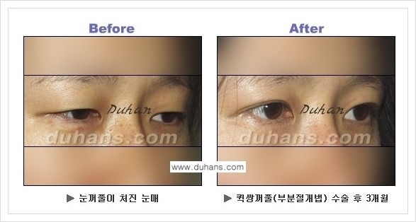 [두한성형외과 경쟁력 눈성형] - [퀵쌍꺼풀 수술 전후 정보 안내 ②] 관련 이미지 13