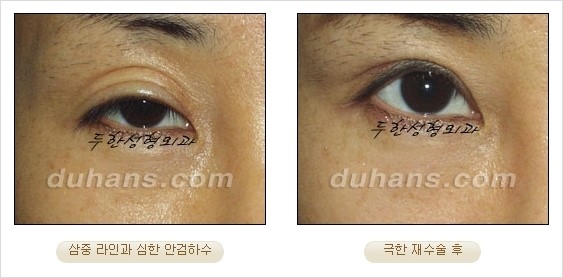 [두한성형외과 경쟁력 쌍꺼풀 재수술 리더 ] - [쌍꺼풀 재수술 과정, 쌍꺼풀 재수술 실패의 원인, 극한 재수술] 관련 이미지 25