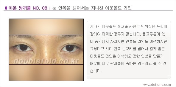 [두한성형외과 경쟁력 쌍꺼풀 재수술, 극한 눈재수술] - [Dr. 컬럼 - 재수술의 목표] 관련 이미지 11