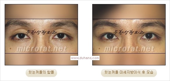 [두한성형외과 경쟁력 쌍꺼풀 재수술, 극한 눈재수술] - [어색한 쌍꺼풀 라인을 교정하는 윗눈꺼풀 미세지방이식] 관련 이미지 18