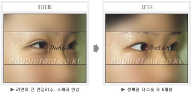 두한성형외과 쌍커풀 재수술 - 짝눈 눈매교정, 가성 안검하수 교정과 뒤밑트임 관련 이미지 49