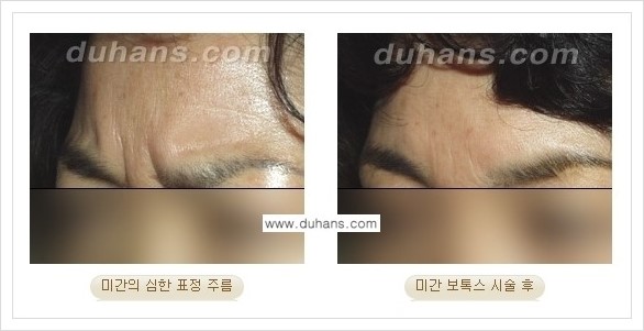 [두한성형외과 경쟁력 주름교정] - [간단 주사요법 - 보톡스 시술 안내 ②] 관련 이미지 4