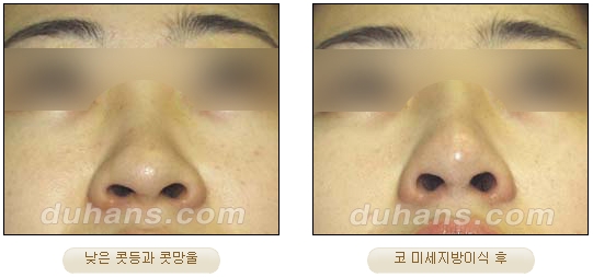 [Duhan Plastic Surgery Facial Autologous Fat Grafting] - [Fat Grafting Guide] image 10