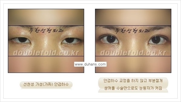 [두한성형외과 경쟁력 쌍꺼풀 재수술(극한 재수술)] - [안검하수(졸리운 눈매) 교정 안내 1.] 관련 이미지 5