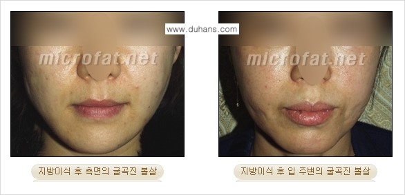 [두한성형외과 경쟁력 미세지방이식] - [타병원에서의 미세지방이식 이후 부작용 교정의 대상 안내] 관련 이미지 9