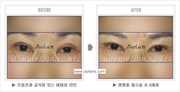 [두한성형외과 쌍꺼풀 재수술] - [지나친 아웃폴드 라인의 쌍꺼풀 재수술] 관련 이미지 6