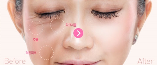 Duhan Plastic Surgery Combo Program - Dark Circles and Lifting image 1