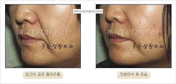 [두한성형외과 경쟁력 주름성형] - [입가주름과 코옆 팔자주름제거 지방이식 시술의 효과] 관련 이미지 13