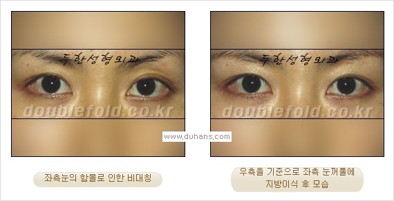 ​⁠⁠[두한성형외과 경쟁력 쌍꺼풀 재수술, 극한 눈재수술] - [지방이식으로 눈매와 쌍꺼풀 라인을 교정] 관련 이미지 12