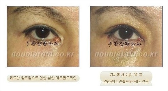 [두한성형외과 경쟁력 눈성형] - [두껍고 수술한 표시가 나는 어색한 쌍꺼풀 라인의 교정 방법] 관련 이미지 19