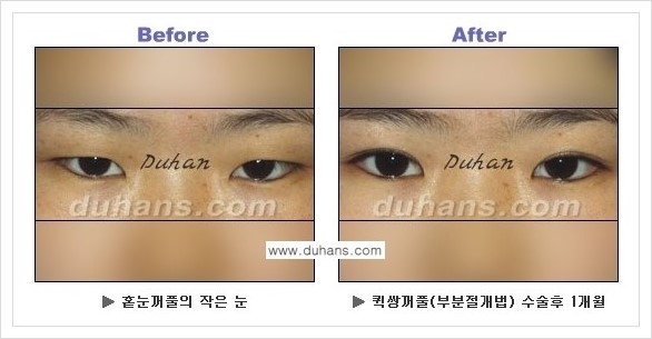 [두한성형외과 경쟁력 쌍꺼풀 재수술, 극한 재수술] - [퀵쌍꺼풀 안내] 관련 이미지 7