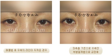 두한성형외과 눈재수술 - 쌍꺼풀 재수술 방법 관련 이미지 11