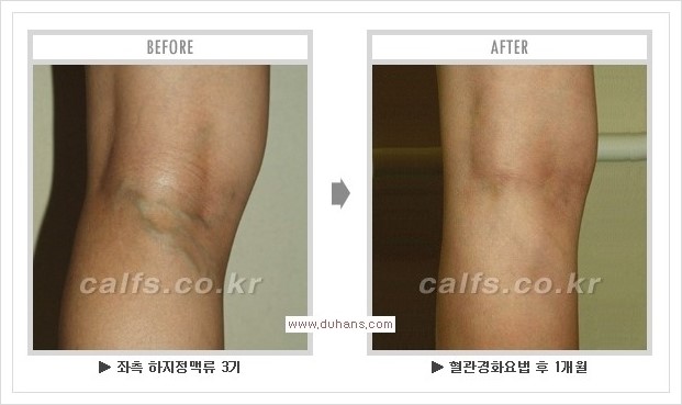 [두한성형외과 경쟁력 멀티종아리성형] - [종아리성형 방법별 전후 주의사항] 관련 이미지 37