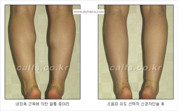 [두한성형외과 Dr. 컬럼] - [종아리 근육퇴축술로 가장 선호하는 비절개 초음파 유도 선택적 신경차단술] 관련 이미지 7