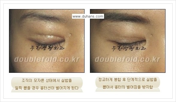 [두한성형외과 경쟁력 쌍꺼풀(눈) 재수술] - [쌍꺼풀(눈) 재수술, 극한 재수술 클리닉의 특성] 관련 이미지 4