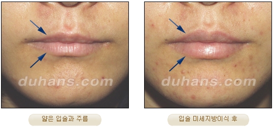 [Duhan Plastic Surgery Facial Autologous Fat Grafting] - [Fat Grafting Guide] image 12