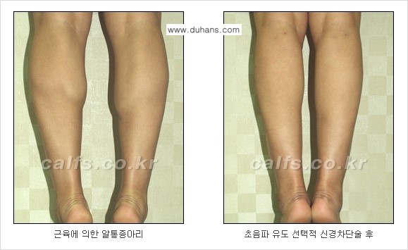 [두한성형외과] - [가을엔 아름답고 매끈한 다리 도전!​] 관련 이미지 2