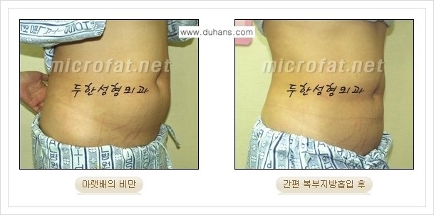 [두한성형외과 경쟁력 바디성형] - [하복부, 팔뚝, 허리선, 허벅지, 엉덩이 간편지방흡입술] 관련 이미지 14