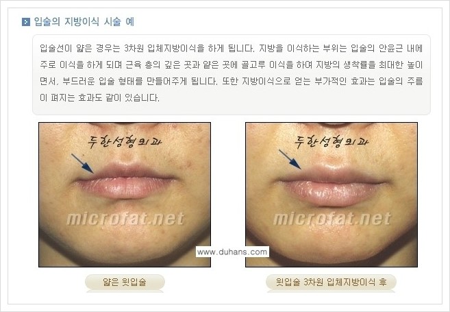 [두한성형외과 경쟁력 미세지방이식] - [입술 미세지방이식 안내 2.] 관련 이미지 1
