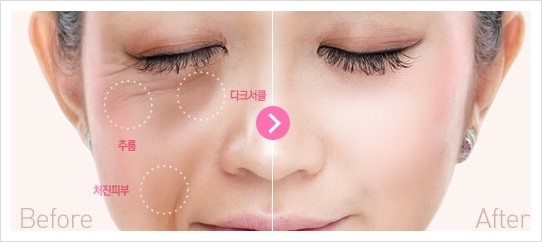 [두한성형외과 콤비프로그램] - [다크써클과 같이 하면 좋은 수술 - "다크써클 + 볼살, 목살 엔도타인 리프팅"] 관련 이미지 1