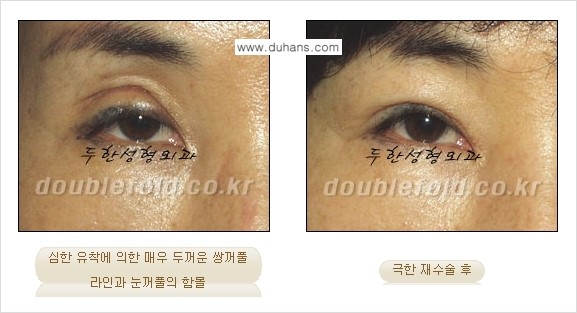 [두한성형외과 경쟁력 쌍꺼풀 재수술, 극한 눈재수술] - [망가진 쌍꺼풀 라인을 교정하는 극한 재수술을  위한 계획] 관련 이미지 9