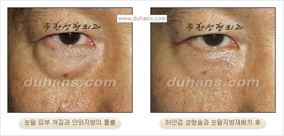 [두한성형외과 경쟁력 다크써클 교정] - [젊어 보이면서 개선된 인상을 주는 하안검 성형술] 관련 이미지 13