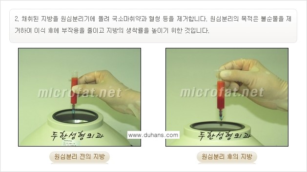 [두한성형외과 경쟁력 미세지방이식] - [얼굴 윤곽 무턱교정 안내 ②] 관련 이미지 3