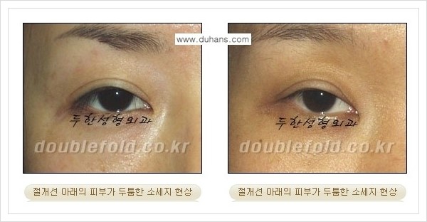 [두한성형외과 경쟁력 쌍꺼풀 재수술] - [절개선 아래가 두툼한 소세지 쌍꺼풀 안내] 관련 이미지 1