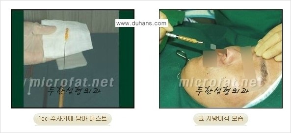 [두한성형외과 경쟁력 코성형] - [미세지방이식을 이용한 자연스러운 코성형 안내] 관련 이미지 9