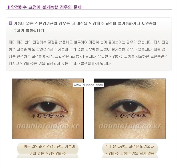 [두한성형외과 경쟁력 있는 쌍꺼풀 재수술] - [극복해야 할 극한의 상황과 문제들] 관련 이미지 10