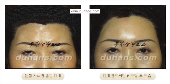 [두한성형외과 경쟁력 주름성형] - [눈썹거상, 앞볼처짐 개선의 엔도타인 리프팅] 관련 이미지 16