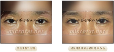 [Doohan Plastic Surgery Autologous Fat Grafting] - [Sunken Eye Fat Grafting] image 36