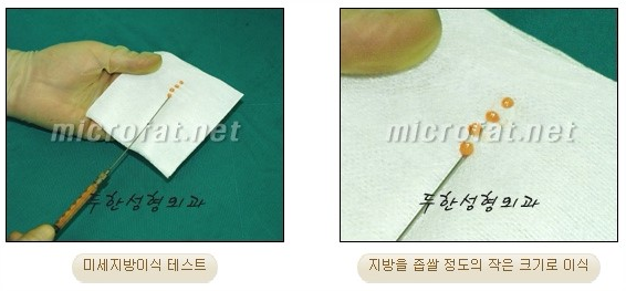 [두한성형외과 자가지방이식] - [3차원 미세지방이식] 관련 이미지 5