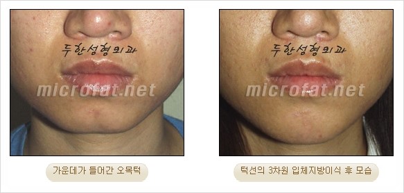 [두한성형외과 경쟁력 지방이식 리더] - [Col-fat(콜펫)지방이식, 3차원 입체지방이식, 2차원 평면지방이식] 관련 이미지 41