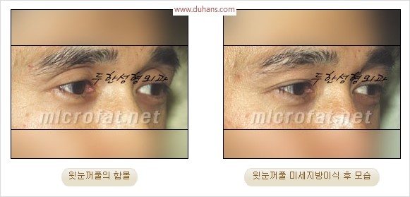 [두한성형외과 경쟁력 눈성형 리더] - [윗눈꺼풀 함몰( #꺼진눈꺼풀) 미세지방이식과 상안검성형]#꺼진눈성형 , #눈위함몰 관련 이미지 27
