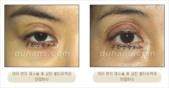 [두한성형외과 경쟁력 쌍꺼풀 재수술 리더 ] - [쌍꺼풀 재수술 과정, 쌍꺼풀 재수술 실패의 원인, 극한 재수술] 관련 이미지 1