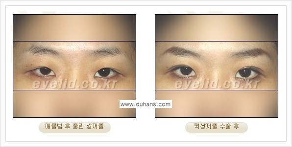 [두한성형외과 경쟁력 눈성형] - [퀵쌍꺼풀 수술] 관련 이미지 11
