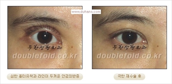 Dr. 컬럼 - 쌍꺼풀 재수술의 부작용을 최소화하는 극한 눈재수술 관련 이미지 4